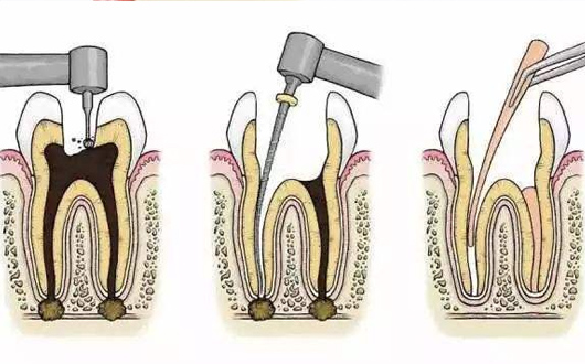根管治疗