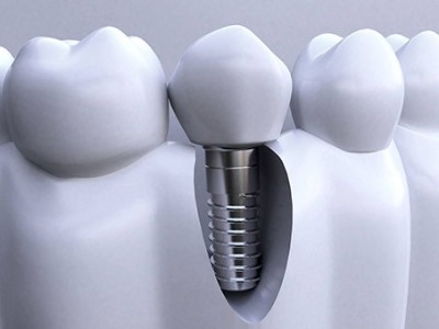 做种植牙全程需要多长时间呢?