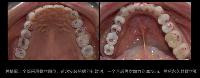 惟德口腔种植&牙齿美白实现了张阿姨想要的牙齿好莱坞白