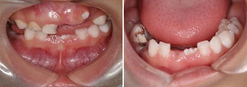 惟德口腔为小朋友的牙齿展开诊疗之路