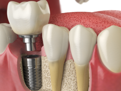 选择种植牙后要做哪些日常维护？
