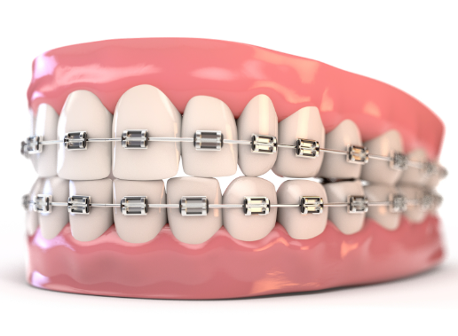 口腔正畸中常见的七个误区