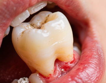 牙齿松动最佳补救方法