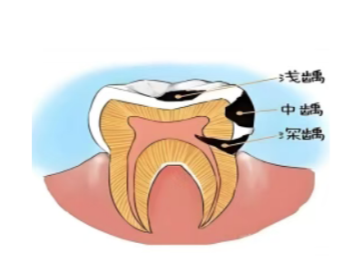 乳牙不是 “过渡品”——保护孩子牙齿从第一颗开始