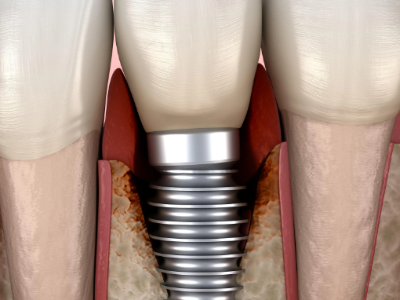 种植牙的术前准备有哪些？