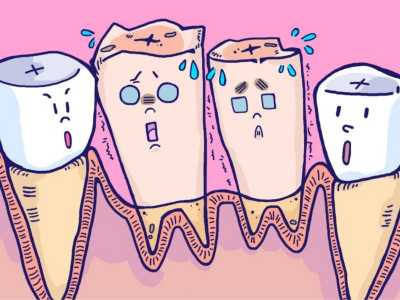 人工种植牙系列——即刻种植术讲解