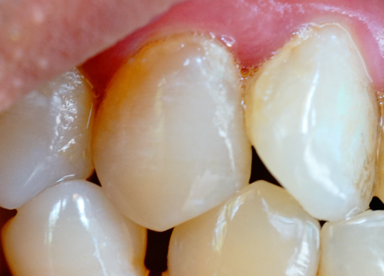 牙齿表面的牙釉质掉了还可以修复吗？