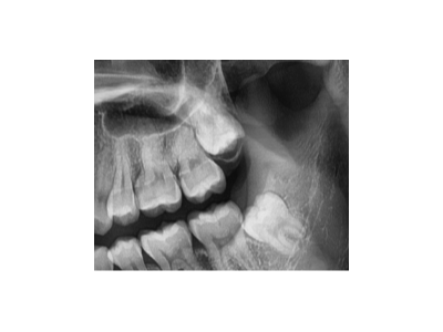 既然「智齿」不宜久留，为什么不能一次性拔掉？