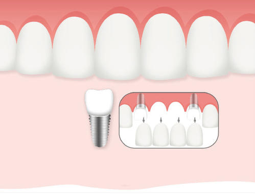 惟德口腔口腔种植怎么样？惟德口腔就来为您一一解答