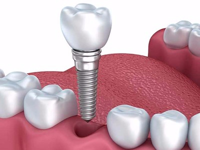 承德种植牙哪个医院比较好【答】
