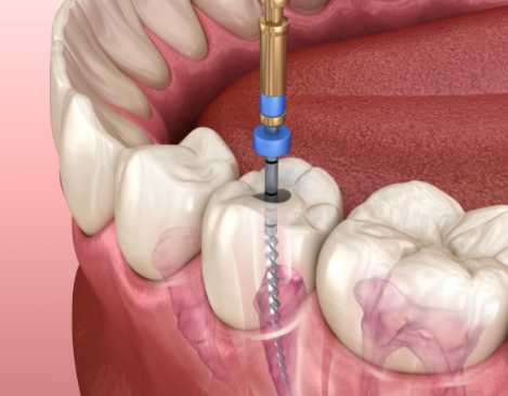 根管治疗后的注意事项有哪些？