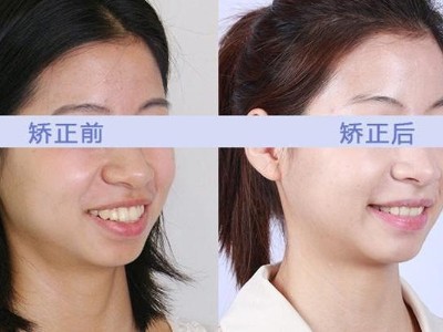 牙齿矫正与正畸的区别及治疗护理要点